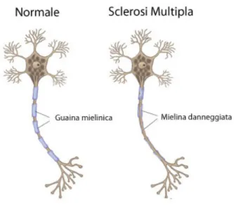 Figura 1.1: A sinistra un esempio di assone sano, mentre a destra quello affetto da sclerosi multipla.