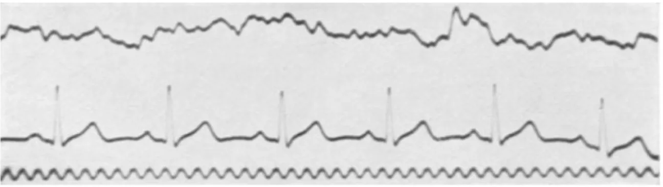 Figura 4. a) Tracciato EEG: ritmo Beta, desincronizzato e rapido; b) tracciato ECG; c) onda sinusoidale a 10  Hz