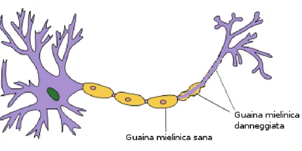 Figura 1.1: Esempio di assone affetto da sclerosi multipla