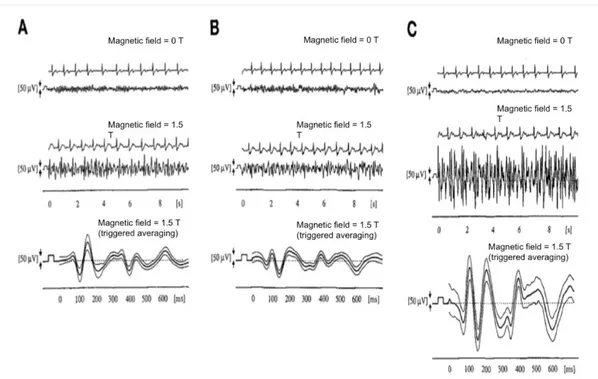 Figure 15 Simultaneous recording of EEG and ECG in one subject, at (A) occipital (Pz-Oz), (B) parietal (P3-O1), and  (C) frontal (F3-Fp1) electrode positions