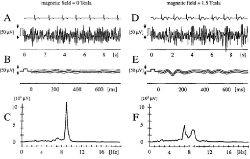 Figure 16 EEG signal at the occipital (Pz-Oz) electrode position, (A)-(C) outside the MR scanner, (D)-(F) inside the  scanner