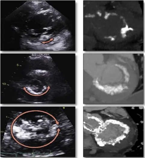 Figura 3 - L'immagine mostra un graduale aumento della gravità della MAC sia tramite immagini ecocardiografiche (sulla sinistra)  sia grazie ad immagini tomografiche (sulla destra).