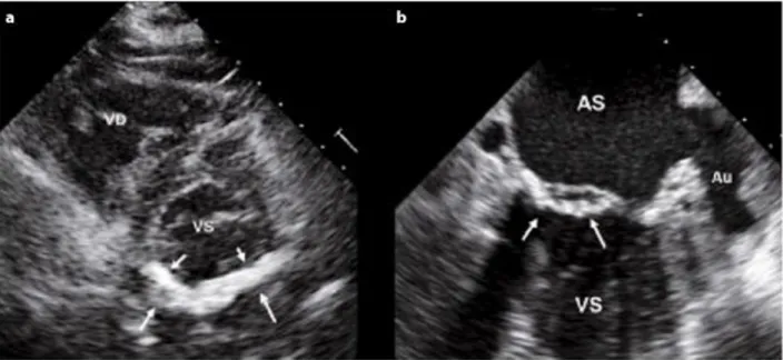 Figura 9 - Sezione asse corto parasternale transtoracico, mostra un’estesa calcificazione che si estende a tutto l’anulus posteriore; b