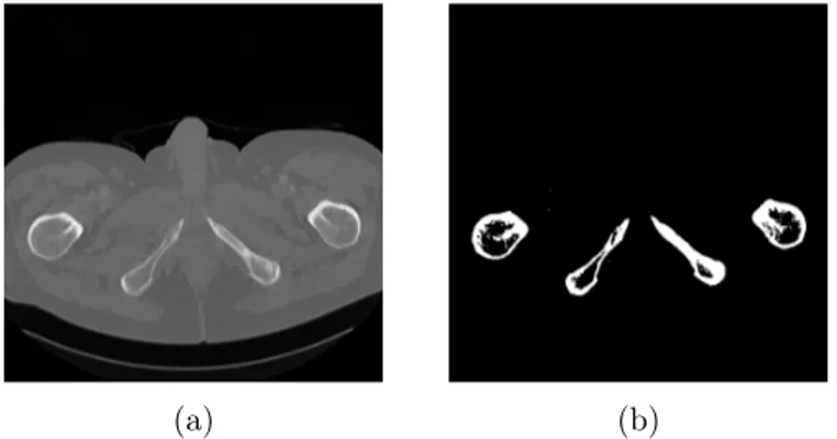 Figure 3.1: Thresholding applied on a CT image for bone segmentation. (a) Original image