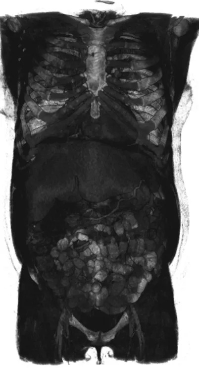 Figure 6.2: 3D view of an abdominal CT scan. The LUT parameters of the MeVisLab viewer are adjusted to show some of the internal structures of the body and not only the skin