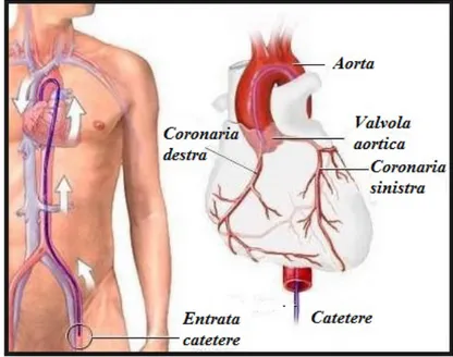 Figura 1.1: Illustrazione raffigurante il punto di accesso e il posizionamento di un catetere per coronarografie