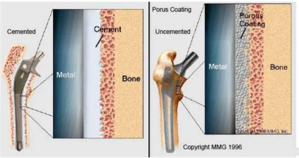 Figure 1.12: Cemented implant (left). Uncemented implant (right) [25]