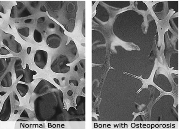 Fig. 6 - Trabecular bone structure in the lower spine of a young adult compared to  an osteoporotic elderly adult