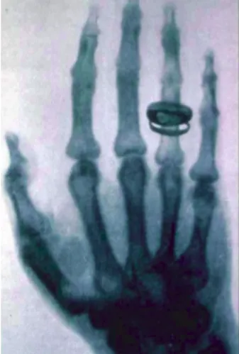 Figura 4 - Una delle prime radiografie effettuate da Roentgen stesso