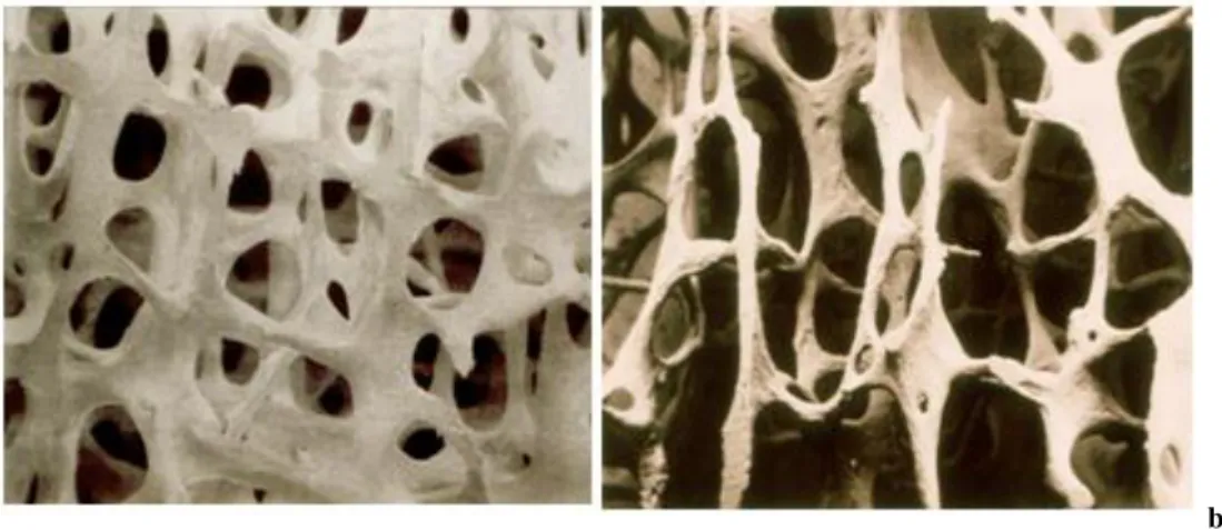 Figure 1.7 : a) Healthy Trabecular Bone vs. b) Osteoporotic Trabecular Bone 