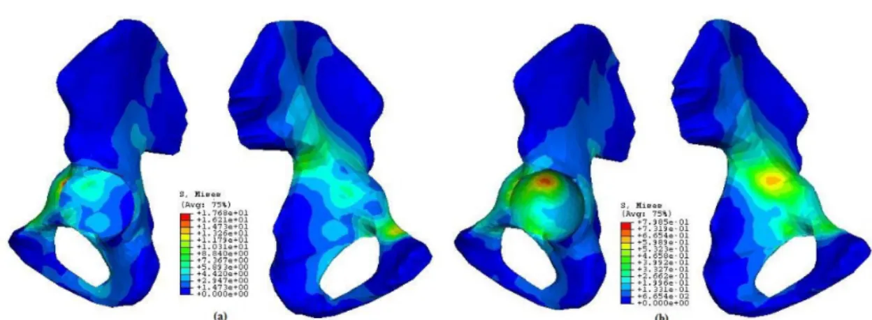 Fig. 7: Stresses distribution over the hemipelvis: a) stresses in the cortical bone, b)  stresses in the trabecular bone 