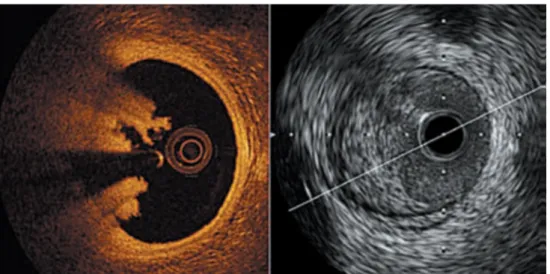 Figura 22. Confronto fra sezioni corrispondenti ottenute con tecnica ecografica ultrasonografica (a destra) e  tomografica a coerenza ottica (a sinistra)
