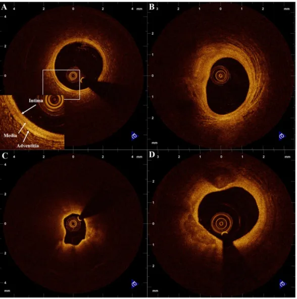 Figura 23. Immagini ottenute con tomografia ottica: A) vaso normale in cui sono evidenziati i 3 strati che  formano la parete, B) placca fibrosa, C) placca ricca di lipidi, D) placca fibrocalcifica