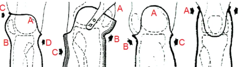 Figura 1.10: Tipologie di invasi per amputazione transtibiale, da sinistra 1-PTS, 2-PTB, 3-PTK vista frontale, 3-PTK vista posteriore
