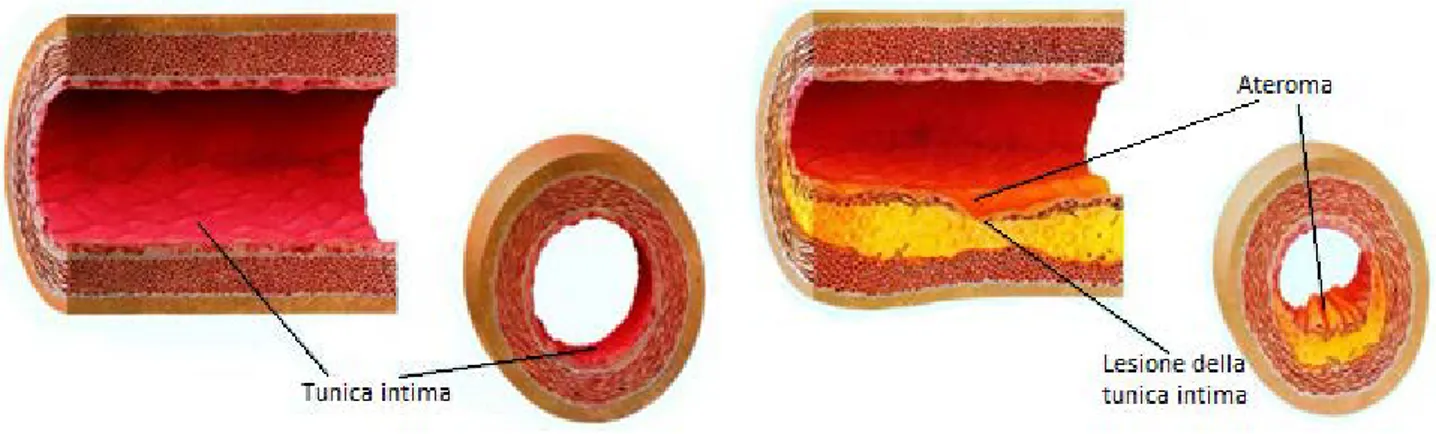 Figura 1 - Aterosclerosi 