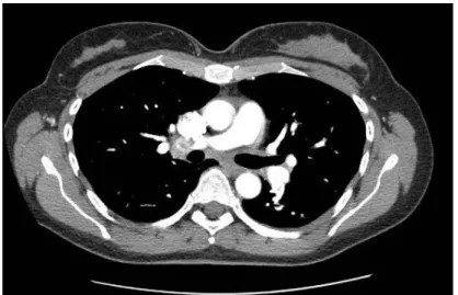 Figura 6:  TC polmonare  