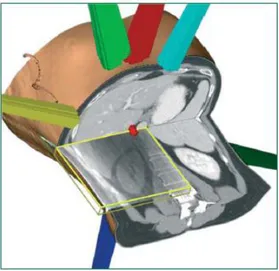 Figura 2  Rappresentazione di un tumore al fegato non operabile mediante tomografia computerizzata a  fascio  conico  lungo  il  piano  coronale  (in  giallo),  acquisita  durante  il  trattamento  per  la  delineazione  del  volume  bersaglio,  e  success