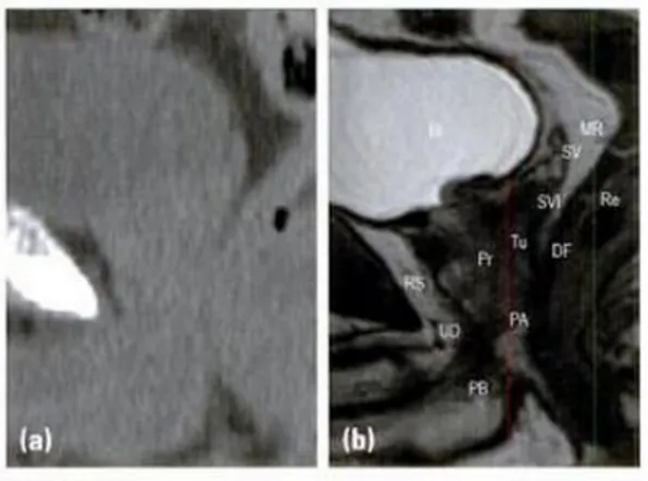 Figura 4 Caso di cancro alla prostata, visione sagittale con immagini di tomografia computerizzata (a), e  di  risonanza  magnetica  (b)