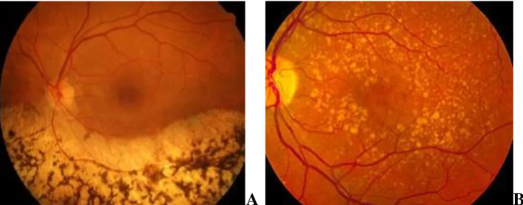 Figura 14 - A) Immagine del fondo oculare in presenza di retinite  pigmentosa. B) Immagine del fondo oculare in presenza di degenerazione 
