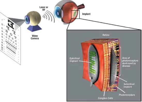 Figura 28 - La protesi retinica cattura l’immagine grazie ad una  videocamera. L’immagine viene elaborata e trasmessa all’unità impiantata, 