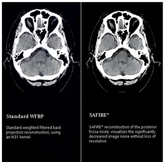 Figure 2.15: Comparison between FBP and Sinogram Reconstruction. Image noise decrease without loss of resolution in the right image [see www.healthcare.siemens.com].
