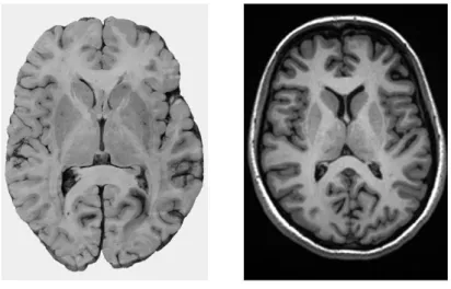 Figure 1.4: Formalin fixed 10-mm-thick brain slice from a male subject [34] (on the left) and axial MR image obtained with a spin-echo sequence (on the right): grey and white matter can be discerned.