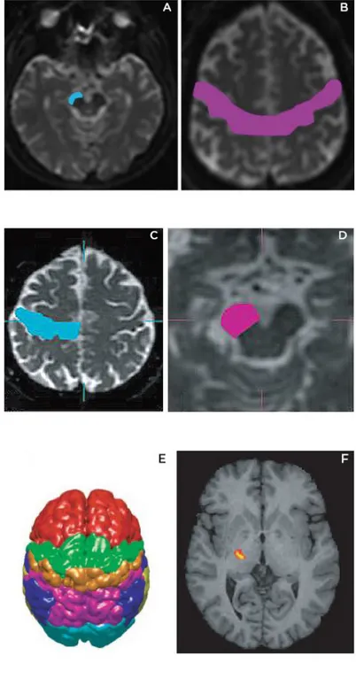 Figure 3.2: Seed masks (on the left) and target ROIs (on the right) used in different stud- stud-ies.(A)and (D) ROIs at the level of the cerebral peduncles; (B)-(C) Seeds at the level of the precentral gyrus and of the motor cortex; (E) Division of the cer