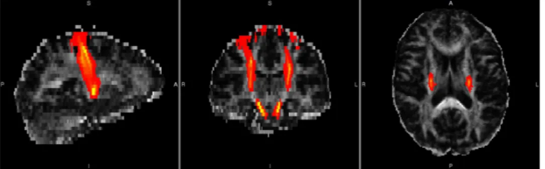 Figure 3.5: Sagittal, coronal and axial views of tracts obtained with various setting options of PROBTRACKX for one healthy subject (N=1).