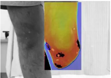 Figura 2.13 Image processing e identificazione di 4 ROI con punti  caldi sull'interfaccia moncone-protesi 