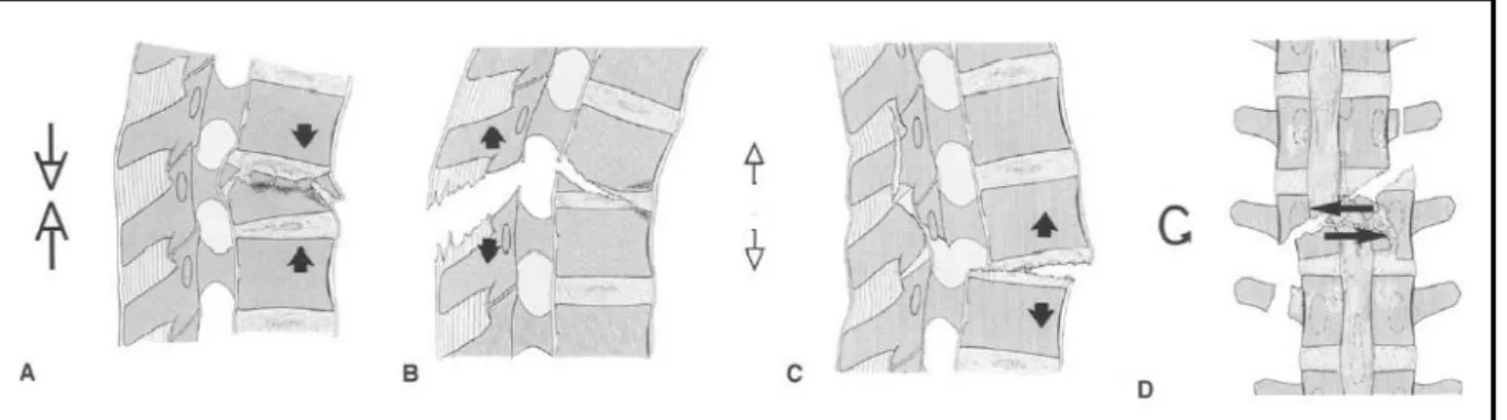 Figura 1. 12: Lesione dovuta a compressione (A); lesione degli elementi anteriori (B) e   posteriori (C) dovute a traslazioni; lesione dovuta a torsione assiale (D)