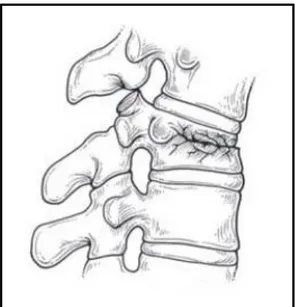 Figura 1. 14: Rappresentazione dell'anterior  wedge  fracture. 