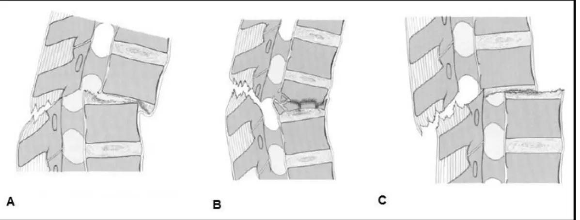 Figura 1. 18: Frattura dovuta a dislocazione anteriore, gruppo B1 (A); frattura della  colonna posteriore associata ad una frattura di tipo A, gruppo B2 (B); frattura dovuta a 