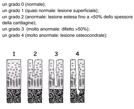 Figura  3.6:  rappresentazione  grafica  dei  diversi  gradi  di  danno  cartilagineo  secondo  la  ICRS: 