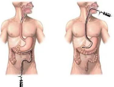 Figura   1.2:   endoscopio   inserito   attraverso   l'ano   (colonscopia,   a   sinistra)   e   la   bocca  (gastroscopia, a destra)  