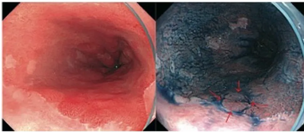 Figura 2.2: lesione nell'esofago di Barrett visualizzata con luce bianca (a  sinistra)   e   con  indaco carminio (a destra)