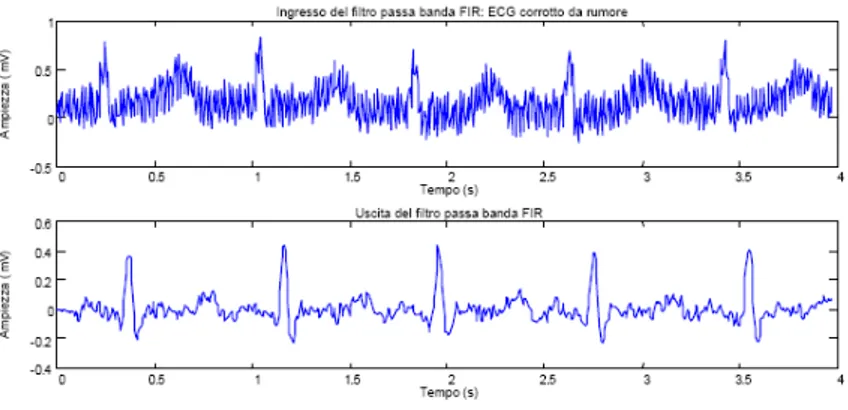 Figura 1.4: ECG affetto da rumore (in alto) e ECG filtrato (in basso)