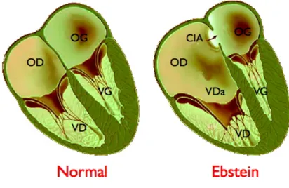 Figura 2.5 Anomalia di Ebstein  Differenza tra un cuore sano e uno malato