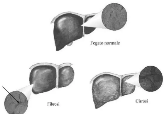 Figura  1.  Nel  fegato  normale  la  presenza  di  matrice  extracellulare  è  limitata  e  l’organo  ha  un  aspetto  liscio