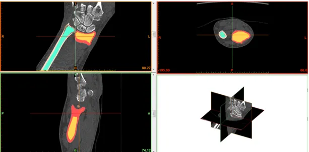 Figure 12. Pink and red masks represented respectively the Ulna and Radius Cortical bone; cyan and  orange masks represented respectively the Ulna and Radius Cancellous bone&#34;