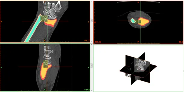 Figure 14. First step to realize the Cartilage Mask&#34;