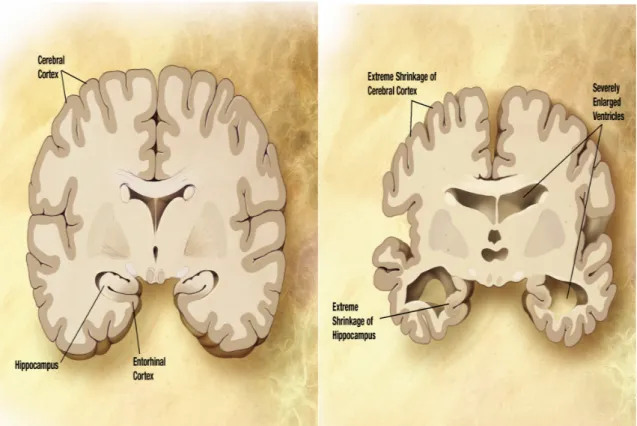 Figure 3.1: Comparison between an healty brain and a brain affected by Alzheimer’s disease