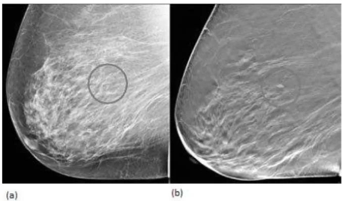 Figura 1.5: Confornto tra mammograa (a) e tomosintesi mammaria (b): il rumore apportato dalla sommazione di ombre