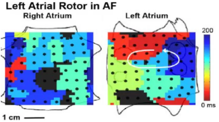 Fig. 18 Individuazione di un rotore attraverso la mappa elettroanatomica in  2D ricostruita dal sistema Rhythm View.[11] 