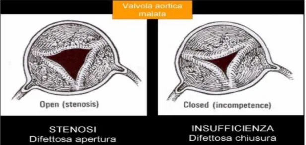 Figura 1.11: Patologie della valvola aortica 