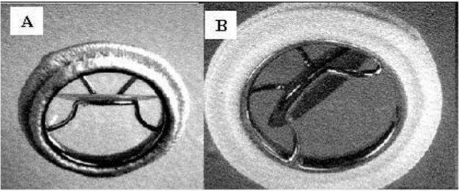 Figura 2.2: a sinistra, valvola Starr-Edwards con palla in gomma siliconica; a destra, flusso  ematico attraverso la valvola 
