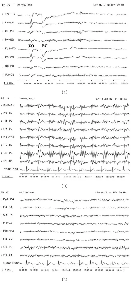Figure 2.4: Example of PA application from [84]: (a) ECG recording from a normal subject outside the scanner, (b) the same subject inside the scanner, (c) the section of EEG illustrated in (b) but with PA subtraction applied.