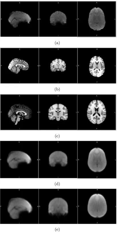 Figure 4.9: Examples of a brain MR slice from (a) a functional volume, (b) structural 3D, (c) standard MNI space, (d) our study specific template (e) our study specific template registered to the MNI.