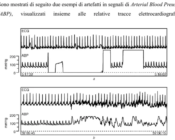 Figura 1.1 Esempi di artefatti in segnali ABP, dovuti a : (a) lavaggio del sistema di  monitoraggio, (b) movimento del paziente [5] 