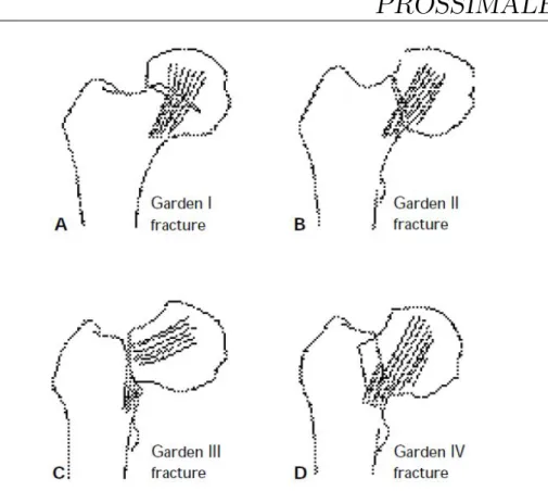Figura 2.3: Fratture del collo di femore[1].