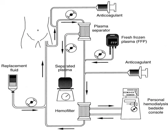 Figura 3.1: Il diagramma del flusso e le condizioni operative dello scambio del plasma unito ad  emodiafiltrazione continua